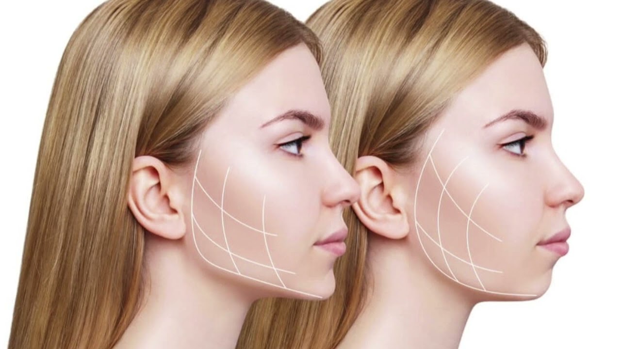 Çene, Yanak Jawline dolgu