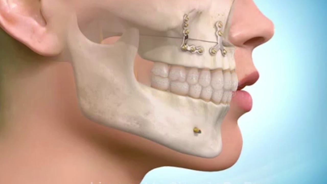 Açık Sinüs Lifting